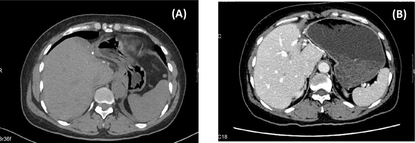 CT scans show two abdominal images labeled A and B. Image A displays a transverse section with the liver and stomach visible, demonstrating internal structures. Image B also shows a transverse view of abdominal anatomy, including the liver and spleen, highlighting varying tissue densities. Both images provide diagnostic insights into abdominal organs.