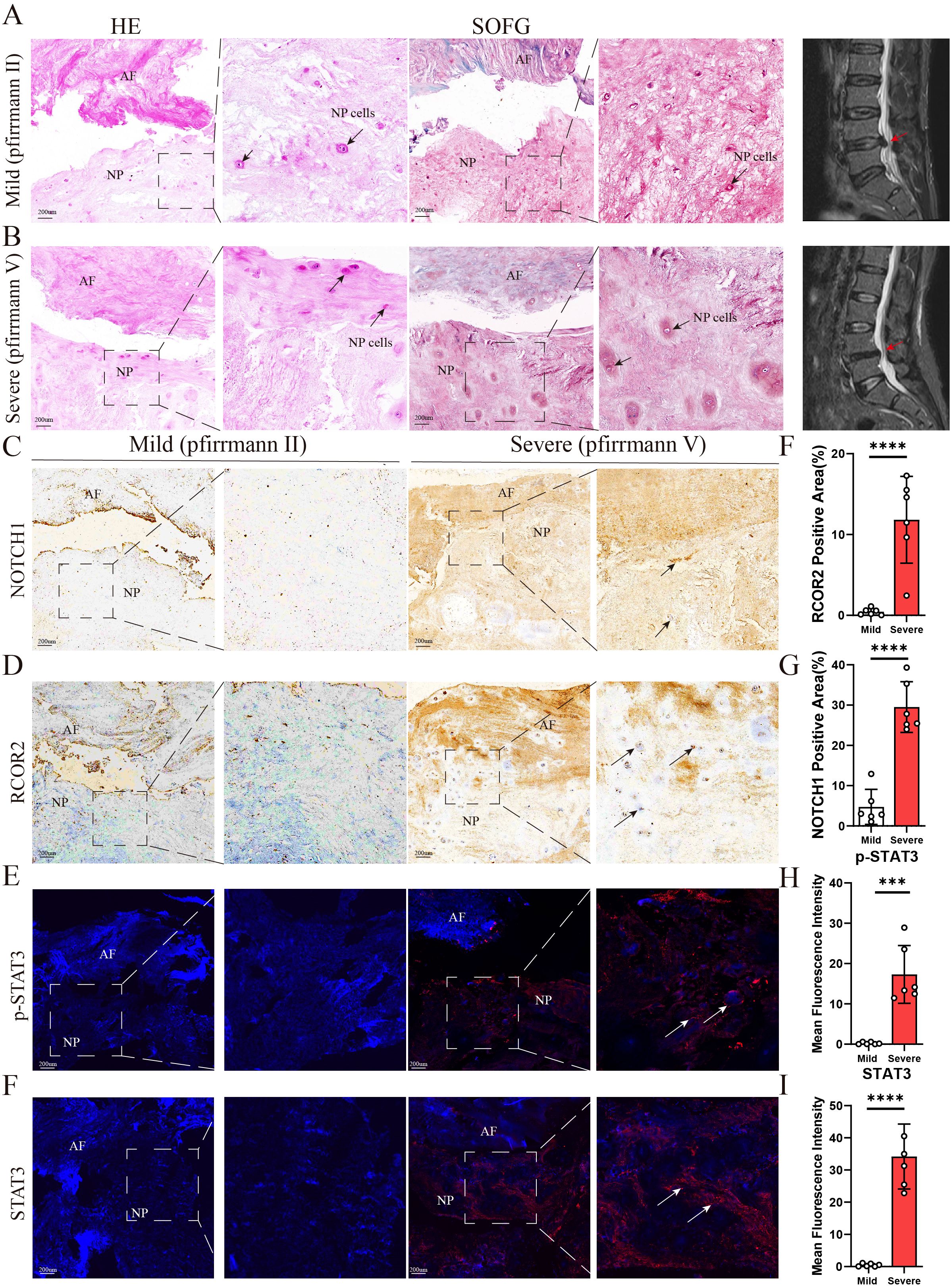 Histological analysis and statistical graphs illustrate changes in intervertebral discs under mild and severe conditions. Panels A and B show HE and SOFG staining, highlighting differences in annulus fibrosus (AF) and nucleus pulposus (NP) areas. Panels C and D display NOTCH1 and RCOR2 expression. Panels E and F depict p-STAT3 and STAT3 fluorescence. Graphs F to I compare RCOR2, NOTCH1, p-STAT3, and STAT3 levels, with significant differences marked by asterisks. MRI images on the right show anatomical context.