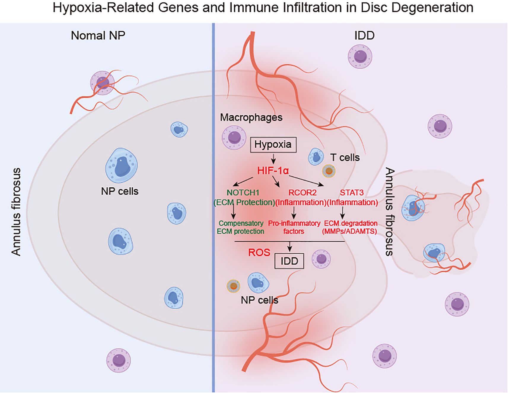 Diagram illustrating hypoxia-related genes and immune infiltration in disc degeneration. It compares normal nucleus pulposus (NP) tissue to degenerating tissue. The left depicts normal NP cells within an annulus fibrosus structure, while the right highlights degeneration with macrophages, T cells, and disrupted pathways involving hypoxia-inducible factor one alpha (HIF-1α). It shows increased inflammation and extracellular matrix (ECM) degradation.