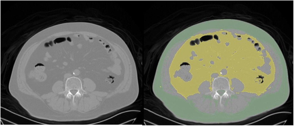 CT scan image of an abdominal cross-section. The left panel shows a standard grayscale view, while the right panel includes color-coded segmentation, highlighting areas in yellow and green.