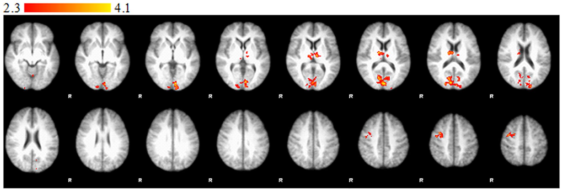 Brain scan images showing two rows of axial slices from an fMRIscan. Bright areas in red and yellow indicate regions of activation, with a scalebarindicating intensity from 2.3 to 4.1. The letter “R” marks the right side in each image slice.