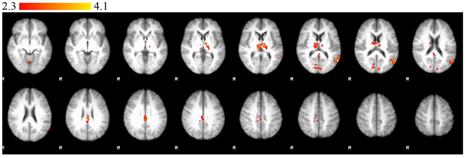 Brain MRI scans displaying slices with highlighted areas in red andyellow, indicating brain activity or specific regions of interest.The scale at the top rangesfrom 2.3 to 4.1.