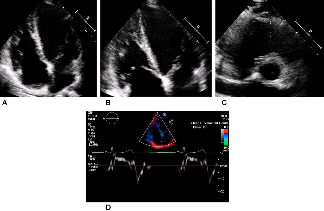 Four echocardiogram images are shown. The first two depict heart chambers in different orientations. The third shows a short-axis view of cardiac structures. The fourth image includes Doppler waveforms with velocity data in color-coded segments and numerical measurements on the side.