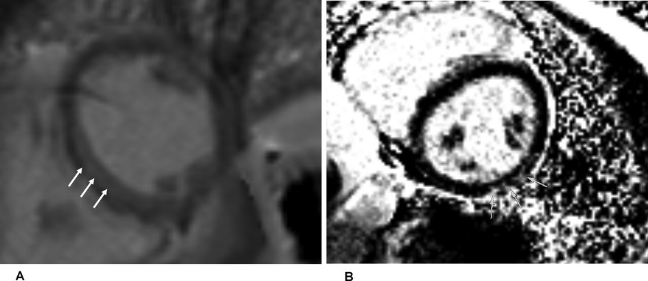 Two MRI scans of a heart are shown. The left image highlights three arrows pointing to a specific area within the heart wall. The right image, in a higher contrast, displays similar arrows pointing to a distinct area on the heart wall, suggesting a focus on a particular aspect of heart tissue.