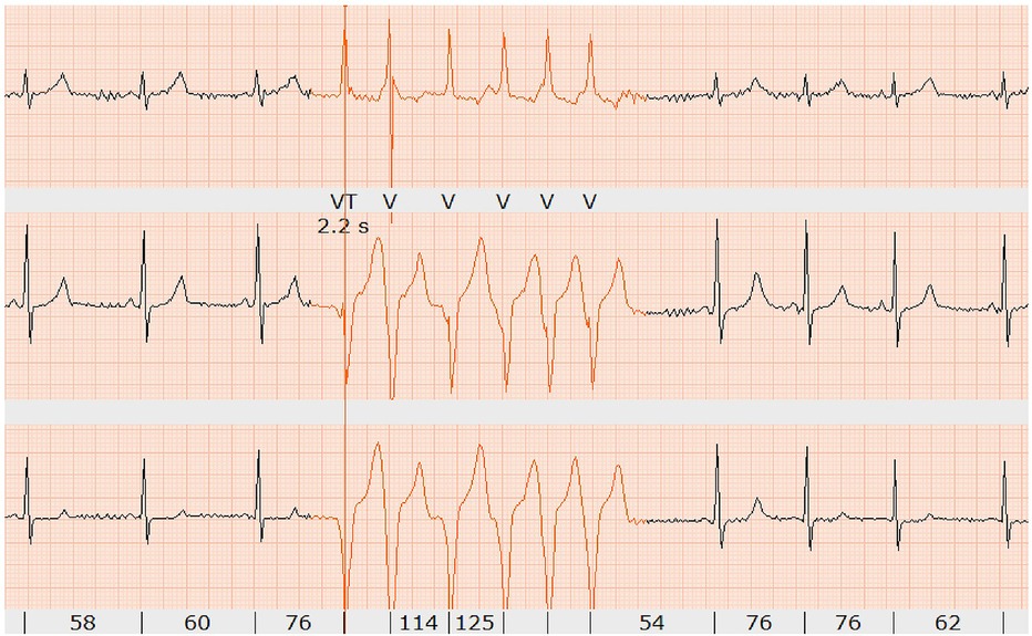 The image shows an electrocardiogram (ECG) recording with three horizontal panels illustrating a brief episode of ventricular tachycardia (VT). The ECG waveform transitions from normal sinus rhythm with distinct P-QRS-T complexes to a rapid, wide-complex tachycardia labeled “VT”, followed by a series of six ventricular beats marked as “V” before returning to sinus rhythm. A duration of 2.2 seconds is noted for the arrhythmic event, and heart rate values are shown below each section. The image highlights the sudden onset and self-termination of VT.