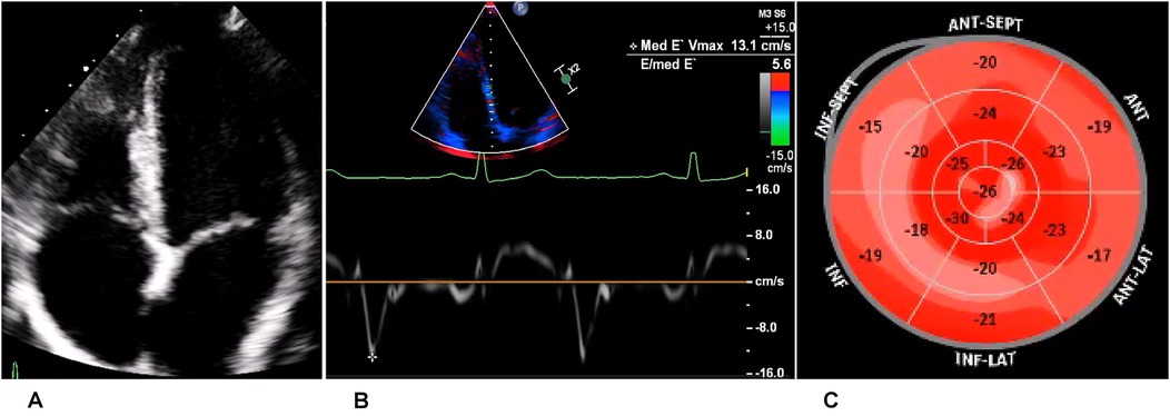 Three-panel image showing cardiac-related visuals. The left panel is an ultrasound scan of the heart. The center panel displays a Doppler echocardiogram with color flow and a velocity graph, indicating a blood flow speed of 13.1 centimeters per second. The right panel is a bullseye chart with multiple red-shaded concentric circles and numerical values, possibly indicating heart strain or segmental speed metrics.