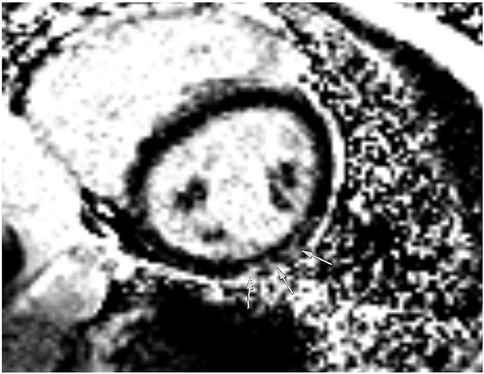 Magnetic resonance imaging (MRI) scan showing a cross-sectional view of the heart. The image highlights two arrows pointing to areas of interest around the heart muscle, likely indicating regions of abnormality or concern. The surrounding tissue appears textured.