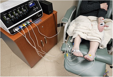 A person seated in a chair with electrodes attached to their wrists and ankles, connected by wires to a scrambler therapy machine. The person is covered with a blanket.