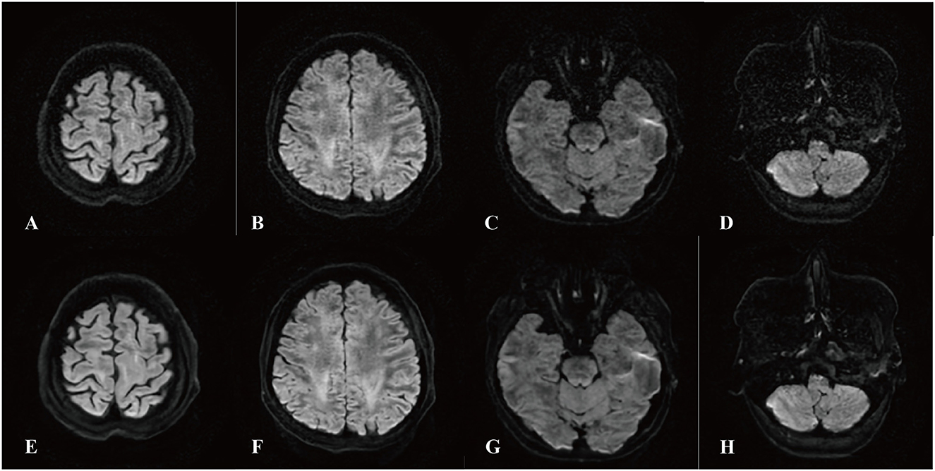 MRI brain scans in two rows showing eight different cross-section images labeled A to H. Each image displays various brain regions, highlighting the brain's structure and contours. The scans are used for medical analysis or research purposes.