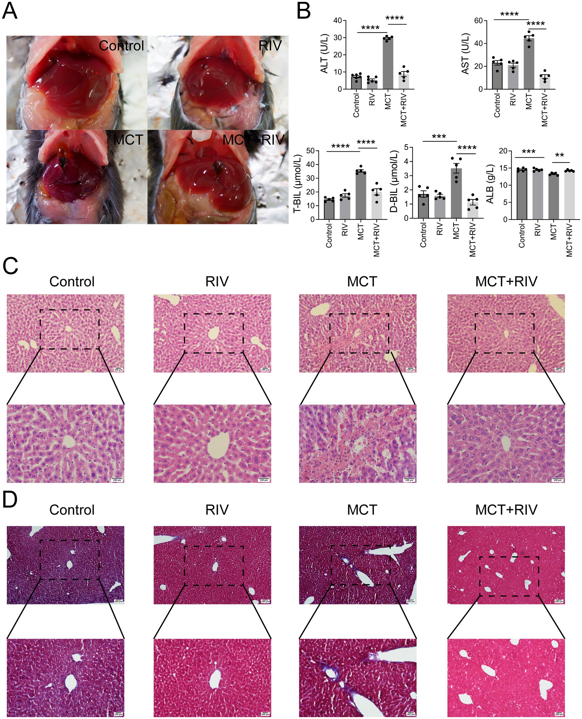 Panel A shows liver images from four groups: Control, RIV, MCT, and MCT+RIV. Panel B contains bar graphs comparing levels of ALT, AST, T-BIL, D-BIL, and ALB across the same groups, with significant differences marked by asterisks. Panel C presents histological liver tissue images with detailed insets from each group. Panel D displays additional liver tissue histology images with magnified sections, highlighting differences among the groups.