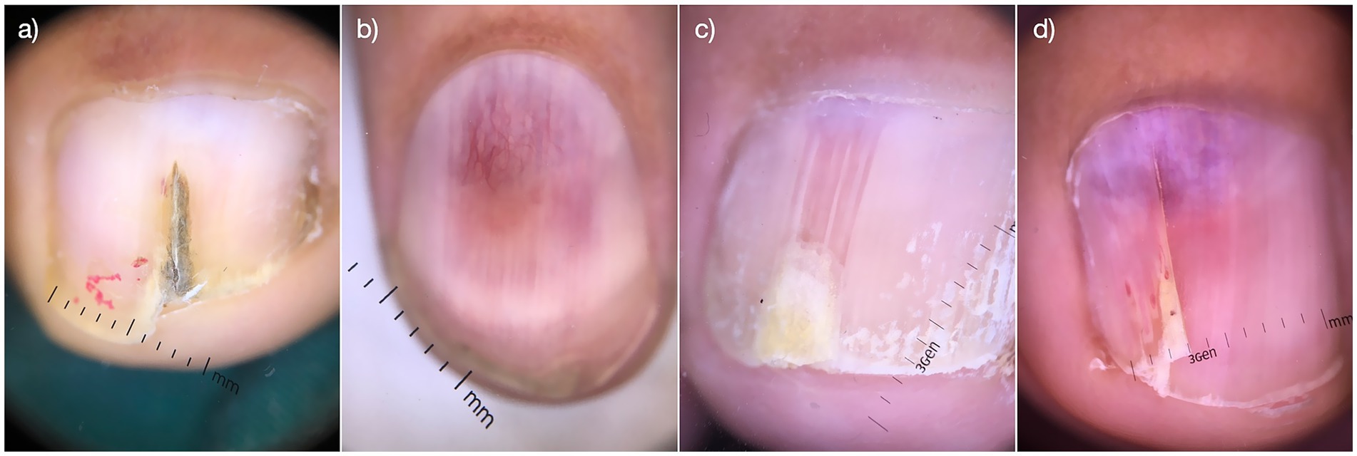 Close-up images of human toenails displaying various conditions. Image a) shows a nail with discoloration and a central split. Image b) depicts a reddish tint with visible blood vessels. Image c) features a nail with scaling and a patchy texture. Image d) highlights discoloration and a long crack. Each image has a millimeter scale for reference.