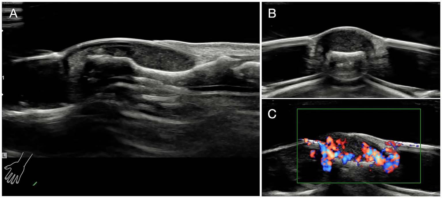 Ultrasound images showing different views of a shoulder joint. Panel A displays a longitudinal view. Panel B shows a cross-sectional view. Panel C includes a color Doppler image highlighting blood flow with red and blue color indications within a outlined area.