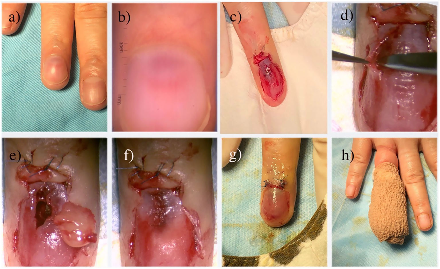 A sequence of images depicting a medical procedure on a finger: (a) Healthy fingers. (b) Close-up of a fingertip. (c) Open wound on the finger. (d) Surgical intervention on the wound. (e, f) Open wound showing sutures. (g) Finger with healing wound and visible stitches. (h) Finger wrapped in a bandage.