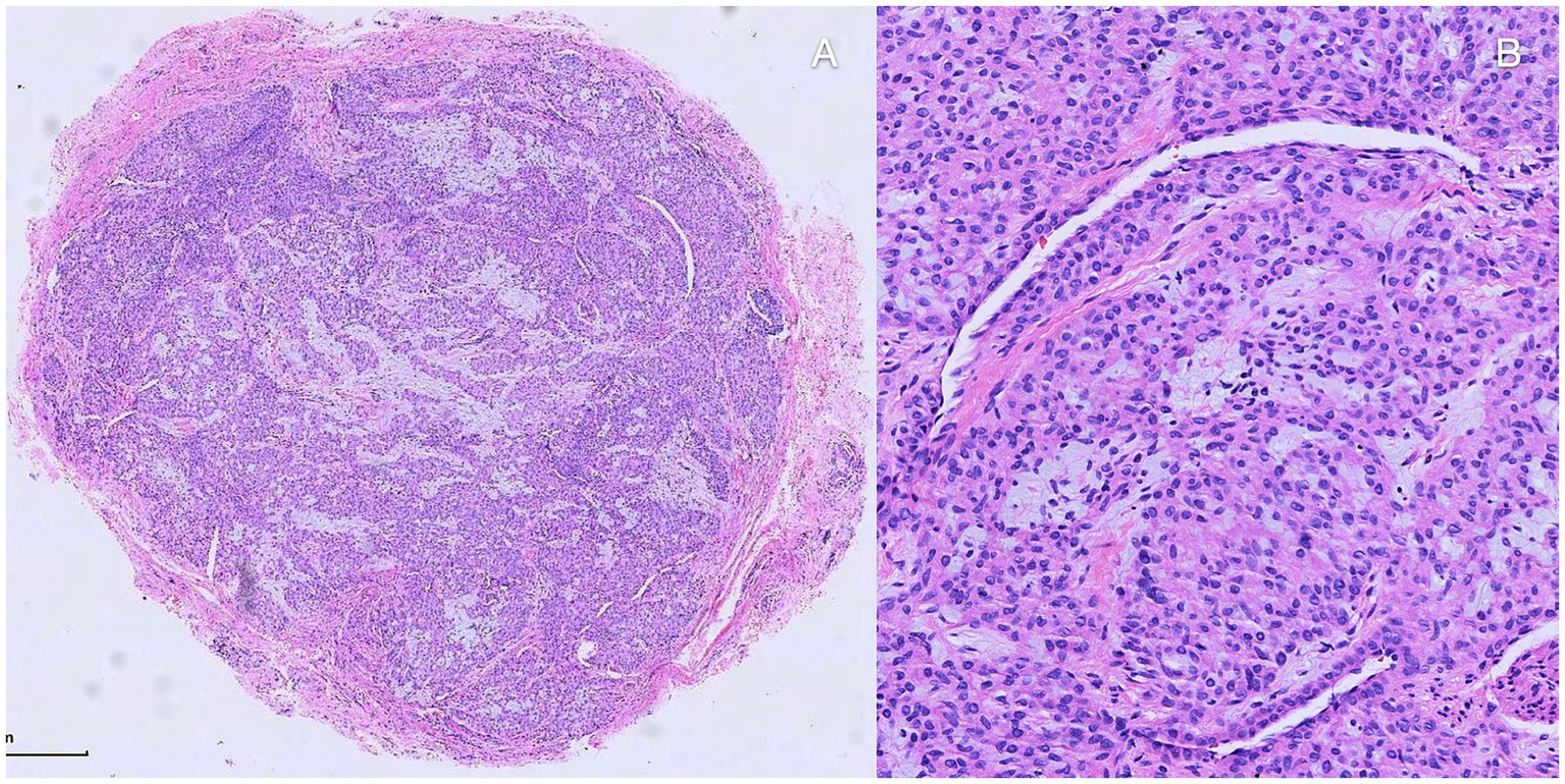 Panel A shows a low-magnification view of a tissue section with dense cellular structures stained purple and pink, indicating varying cell densities. Panel B presents a higher magnification of this tissue, highlighting oval-shaped nuclei and fibrous structures with a pink background. Both are stained using hematoxylin and eosin for histological examination.