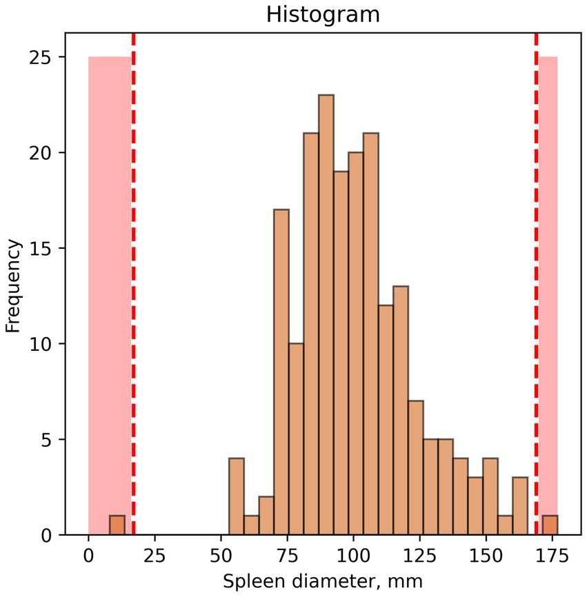 Histogram of spleen diameter measurements in millimeters, showing frequency distribution. Most measurements range between fifty and one hundred fifty millimeters. Dashed red lines indicate notable thresholds at approximately twenty-five and one hundred seventy-five millimeters.