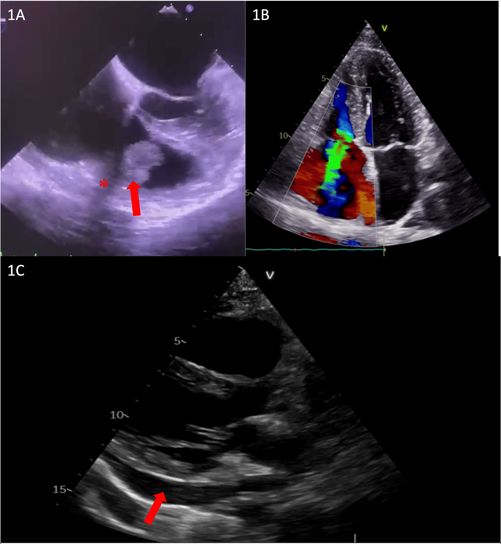 Ultrasound image with three labeled panels. Panel 1A shows a noted structure with a red arrow and asterisk. Panel 1B displays color Doppler flow indicating blood movement. Panel 1C highlights another area with a red arrow, indicating a specific region of interest.