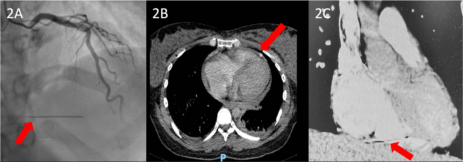 Three-panel image showing medical scans. Panel 2A: Angiogram with a red arrow indicating a detail, possibly a catheter. Panel 2B: CT scan with a red arrow pointing to a structure near the heart. Panel 2C: Sagittal CT image with a red arrow highlighting a position near the spine.