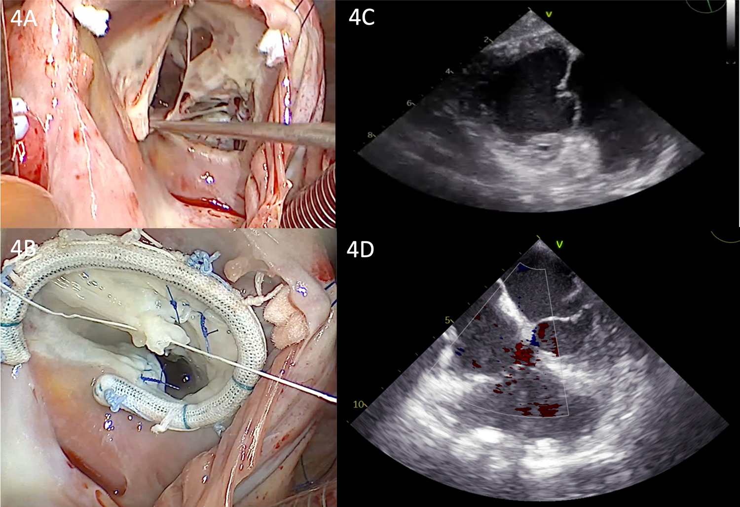 Four-panel medical image showing two surgical views and two ultrasound scans. Panel 4A shows an open surgical view of a heart with surgical instruments. Panel 4B displays a close-up of a heart valve with a circular prosthetic ring and sutures. Panel 4C is an ultrasound image showing the heart's interior structure. Panel 4D depicts another ultrasound image with color flow, indicating blood movement.