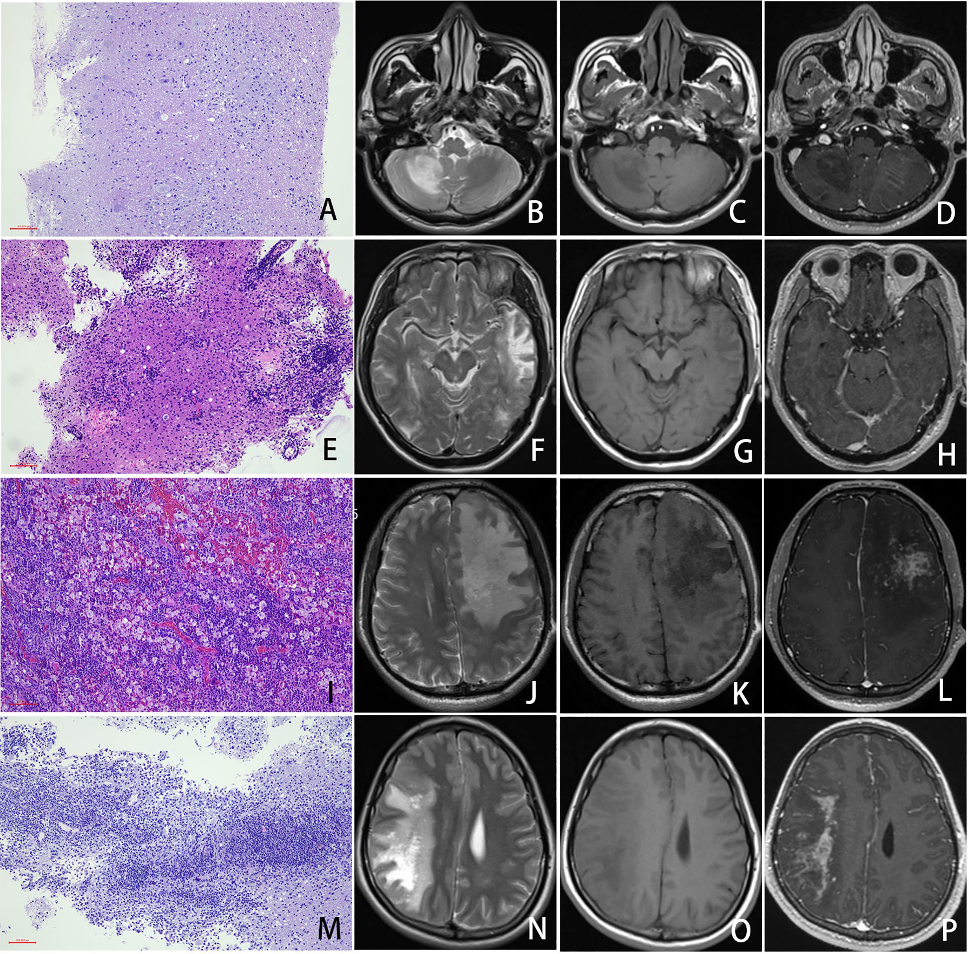 Histopathological slides and corresponding MRI scans of brain tissue are shown in a four-by-four grid labeled A to P. Rows demonstrate variations in tissue appearance and MRI results, highlighting differences in structure and potential abnormalities. Each histological image on the left is paired with three MRI images on the right, indicating a possible correlation between microscopic observations and MRI findings.