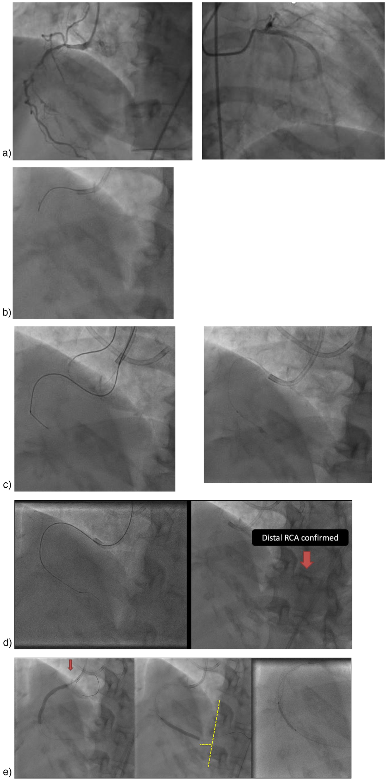 Angiographic images depicting multiple views of the coronary arteries. Panel (a) shows the coronary artery structure. Panel (b) highlights a close-up view. Panel (c) depicts another angle of the arteries with catheter positioning. Panel (d) confirms the distal RCA with an arrow. Panel (e) includes marked lines indicating specific areas of interest in the arteries.