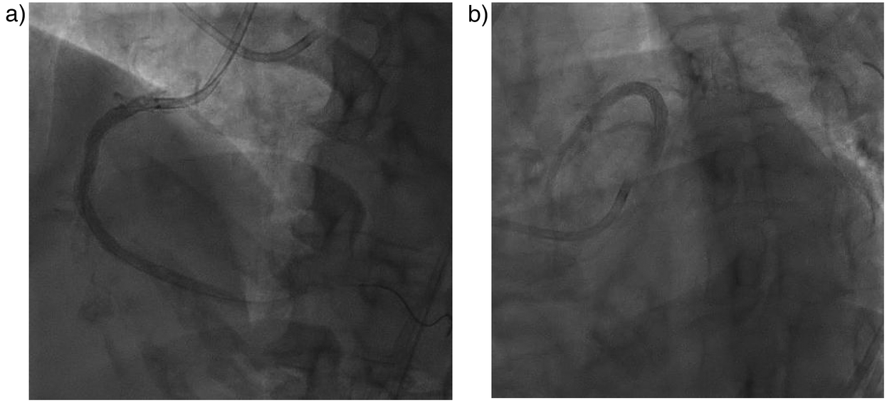 Fluoroscopic images in two panels: (a) shows a guidewire navigating a heart vessel, forming a curved path. (b) displays a similar guidewire path in another vessel, demonstrating variations in placement.