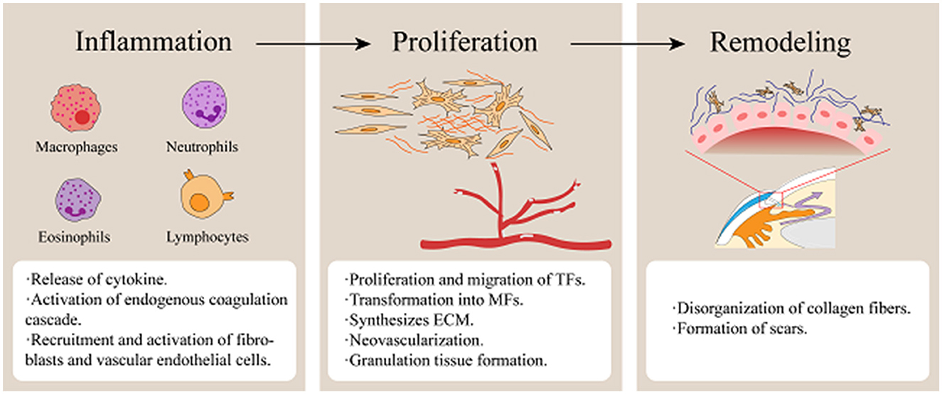 Diagram illustrating three phases of wound healing: Inflammation, Proliferation, and Remodeling. Inflammation shows macrophages, neutrophils, eosinophils, and lymphocytes, with notes on cytokine release and cell recruitment. Proliferation depicts tissue formation and neovascularization. Remodeling illustrates collagen disorganization and scar formation.
