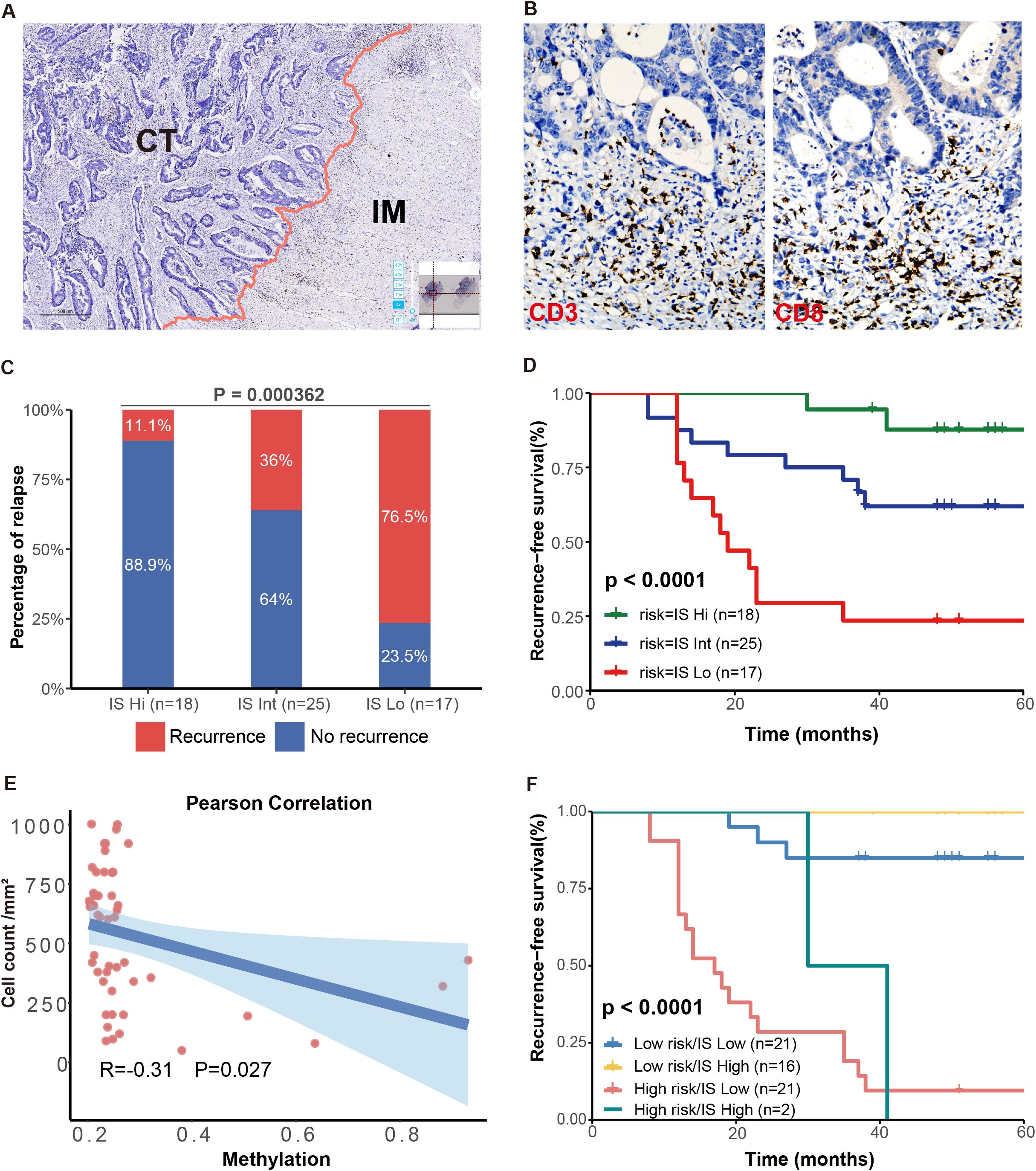 Panel A shows a histological contrast between cancer tissue (CT) and immune microenvironment (IM). Panel B displays immunohistochemical staining, highlighting CD3 and CD8 markers. Panel C presents a bar chart showing relapse percentages in high, intermediate, and low immune scores (IS), with statistical significance (p = 0.000362). Panel D features a Kaplan-Meier plot for recurrence-free survival across different IS risk groups, showing significant differences (p < 0.0001). Panel E depicts a scatter plot with Pearson correlation between methylation and cell count, with R = -0.31 and p = 0.027. Panel F is another survival plot comparing low and high IS risk groups, also significant (p < 0.0001).
