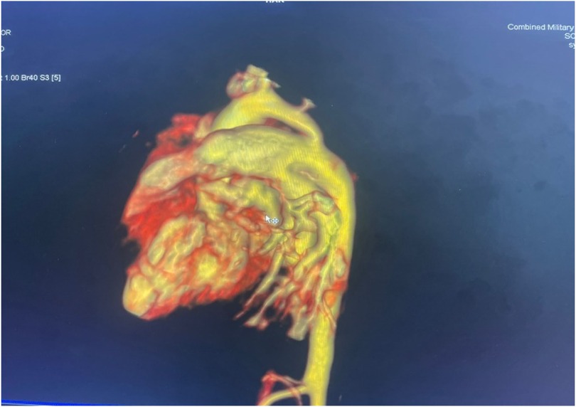 A medical imaging scan shows a detailed view of a human organ, possibly a heart, in yellow and red tones against a dark background. The image features complex structures and vessels.