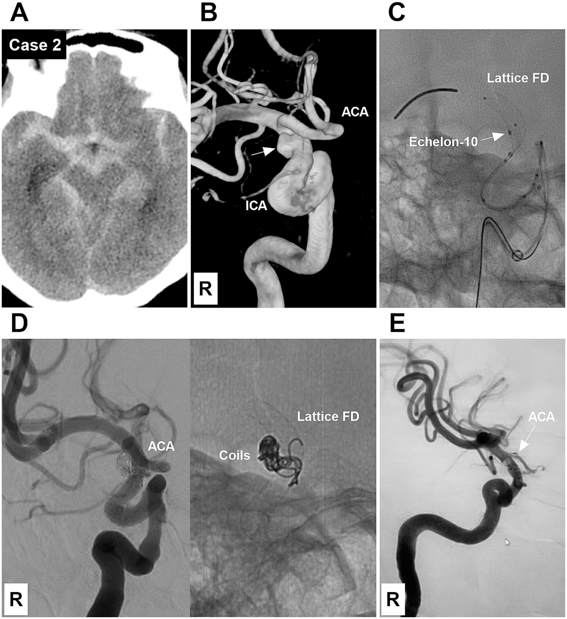 CT and angiographic images from a medical case study. Image A shows a CT scan of the brain. Image B displays 3D vessel reconstruction with labeled ACA (anterior cerebral artery) and ICA (internal carotid artery). Image C presents a fluoroscopy with Lattice FD and Echelon-10 markers. Image D depicts angiographic imaging of ACA with a view of coils and Lattice FD. Image E illustrates another angiographic view highlighting the ACA.