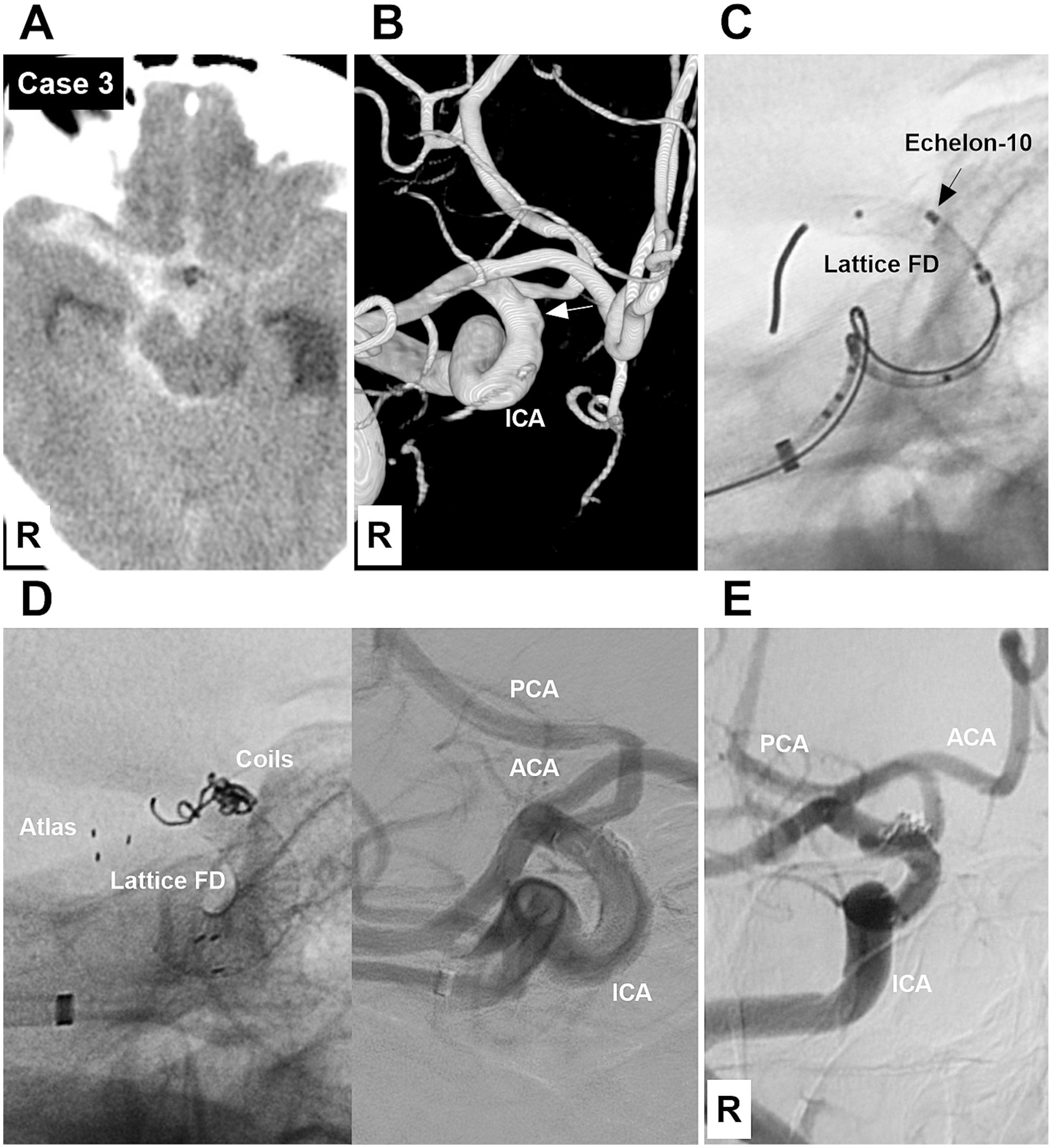 CT and angiography images from Case 3 show cerebral arteries. Panel A displays a CT scan of the brain. Panel B shows a 3D rotational angiography with a visible internal carotid artery (ICA). Panel C depicts an angiographic view of an Echelon-10 microcatheter and Lattice flow diverter. Panel D illustrates the placement of coils and the Lattice flow diverter in the cerebral artery with labeled PCA, ACA, and ICA. Panel E presents another cerebral angiogram highlighting the ICA, ACA, and PCA. Labels indicate arteries and medical devices.