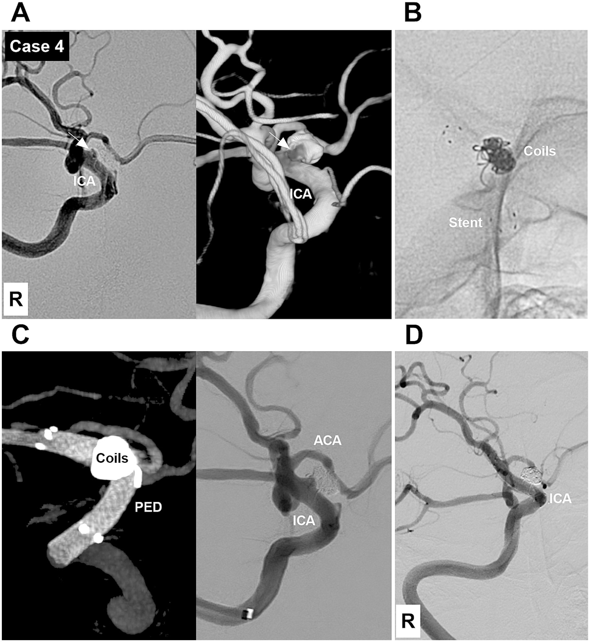 Medical images depict cerebral angiography across four panels labeled A to D, demonstrating case four. Panel A shows before-treatment images with an aneurysm near the internal carotid artery (ICA). Panel B demonstrates coiling and stent placement. Panel C presents images after flow diversion with coils and Pipeline Embolization Device (PED) in place. Panel D shows post-treatment vascular flow in the ICA and anterior cerebral artery (ACA).