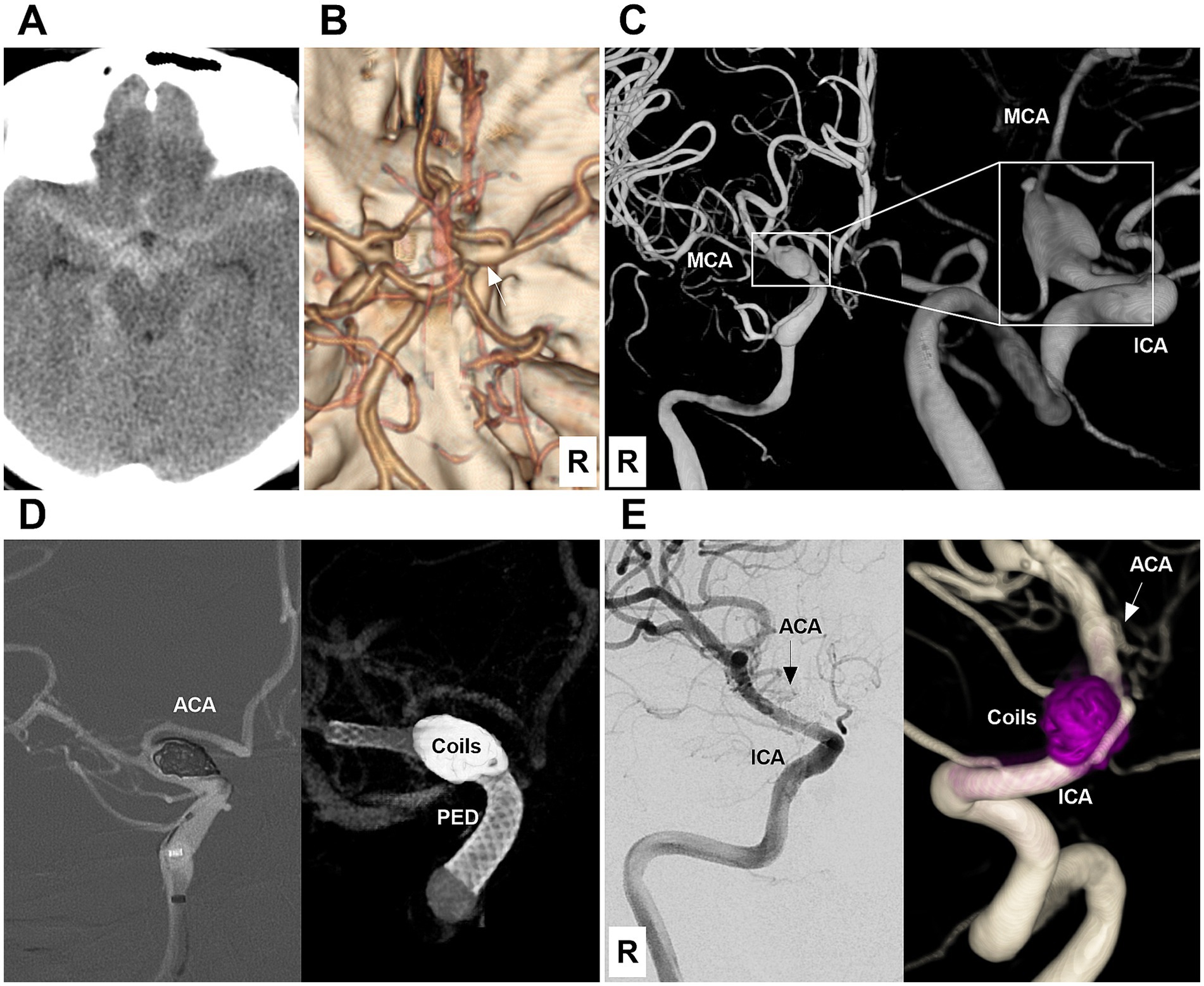 Composite medical images showing cerebral arteries:A) CT axial scan depicts a brain cross-section.B) 3D angiogram highlights intricate vessels.C) Angiogram of middle (MCA) and internal carotid arteries (ICA), with a box focus.D) Image displays anterior cerebral artery (ACA) with coils labeled.E) Angiogram and 3D rendering of ACA and ICA with marked coils and aneurysm.