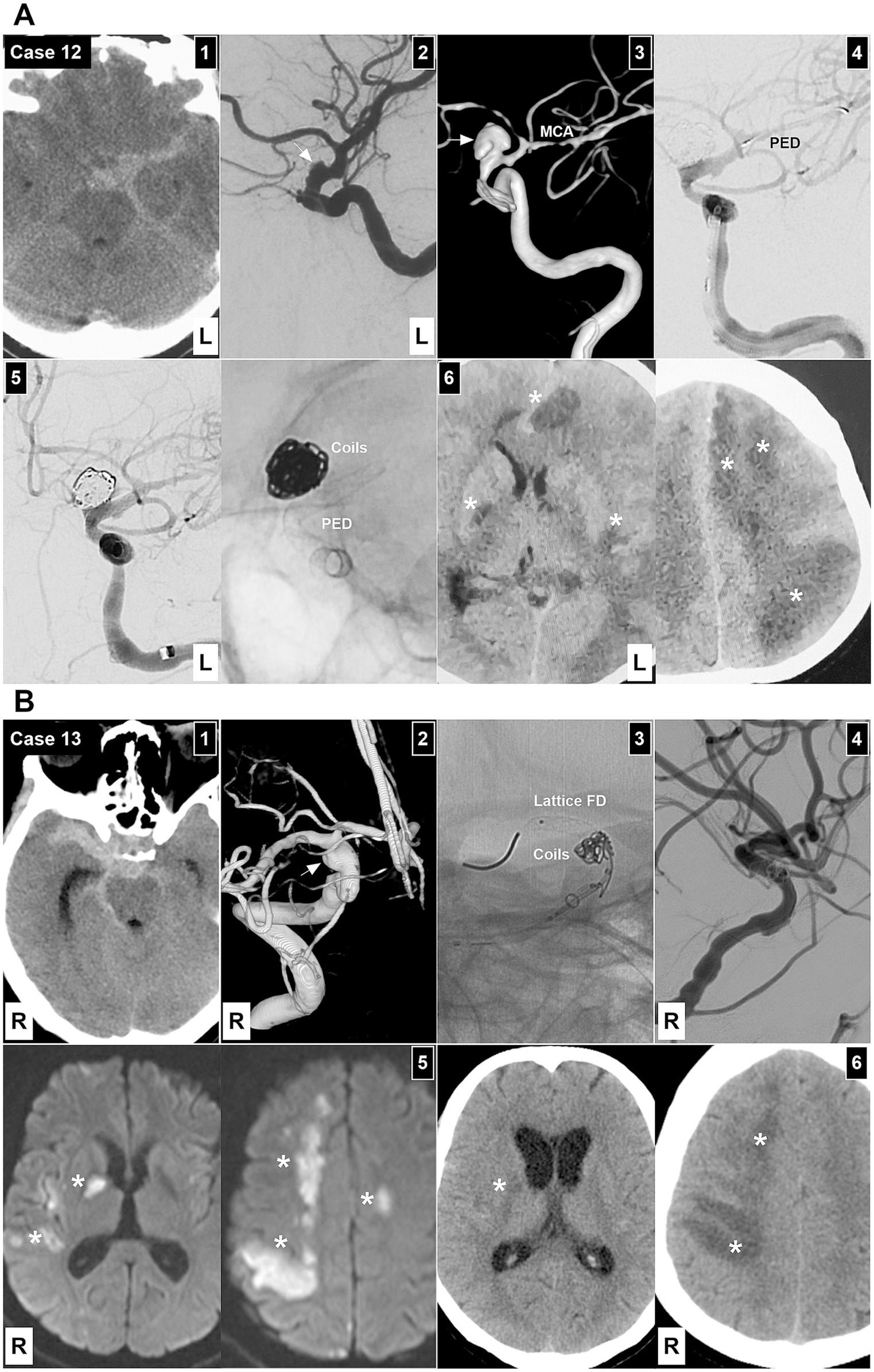 Panel A displays six medical images related to Case 12. Image 1 shows a CT scan of the brain, Image 2 is an angiogram with a highlighted vessel, Image 3 is a 3D reconstruction of the middle cerebral artery (MCA), Image 4 shows a pipeline embolization device (PED), Image 5 features coils and PED in the vessel, and Image 6 presents a CT scan with marked regions.Panel B contains six medical images for Case 13. Image 1 shows a CT scan of the brain, Image 2 depicts a 3D vascular reconstruction, Image 3 highlights a lattice flow diverter and coils, Image 4 is an angiographic image, Image 5 displays a brain scan with marked lesions, and Image 6 provides another CT scan with emphasized areas.