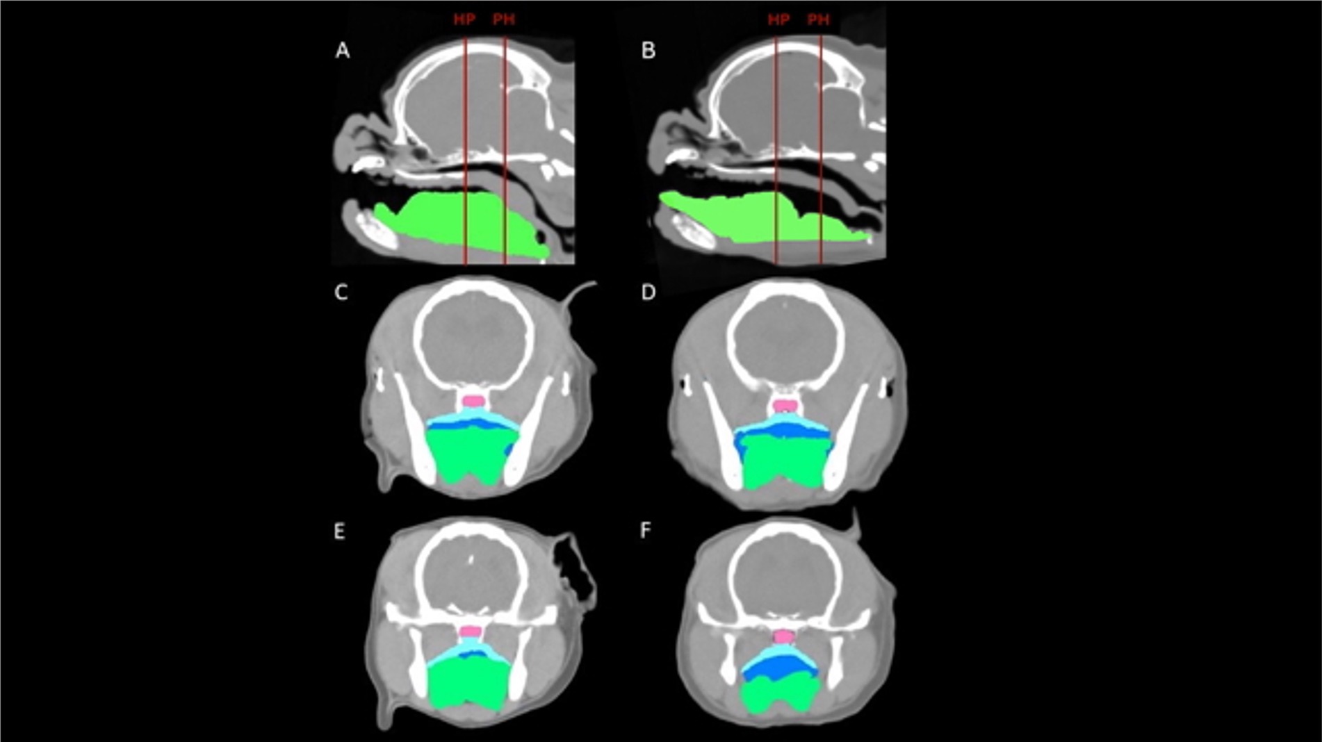 CT scans divided into panels A to F. Panels A and B show sagittal views with colored regions and red lines labeled HP and PH. Panels C to F display transverse views with green, blue, and pink highlighted areas, illustrating different tissue sections. Black background.