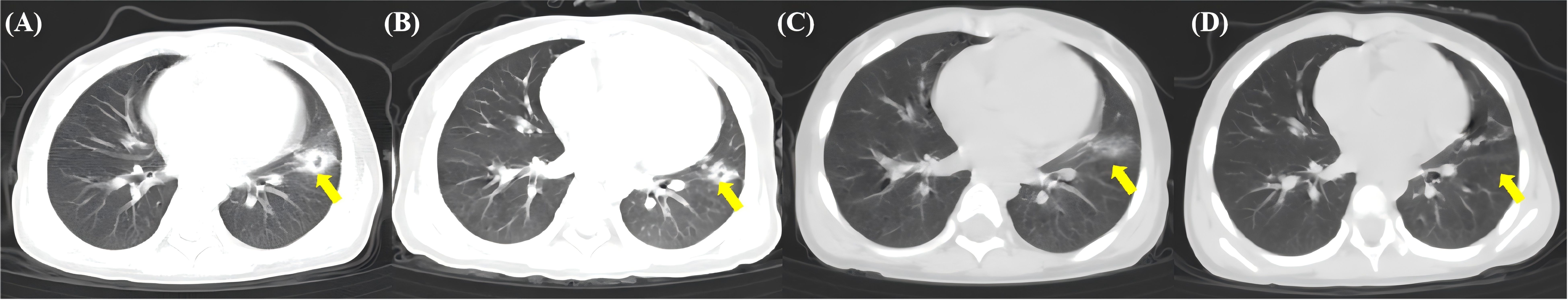 CT scan images labeled A to D show cross-sections of the lungs, each with a yellow arrow indicating a specific area of interest. The sequence appears to highlight changes in the lung tissue over time.