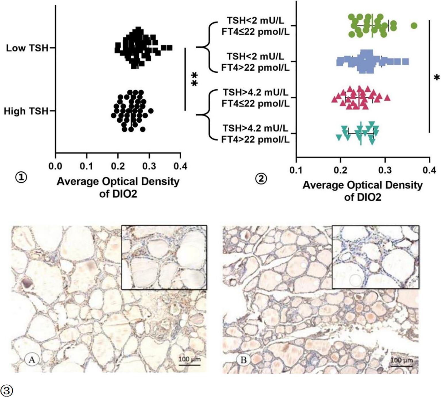 Graphical data showing the average optical density of DIO2. Panel ① compares low and high TSH levels, indicating differences marked with an asterisk. Panel ② categorizes data into four TSH and FT4 combinations, highlighting significant variance. Panels labeled A and B display microscopic images of tissues, each with insets magnifying the structures, and scale bars of one hundred micrometers.