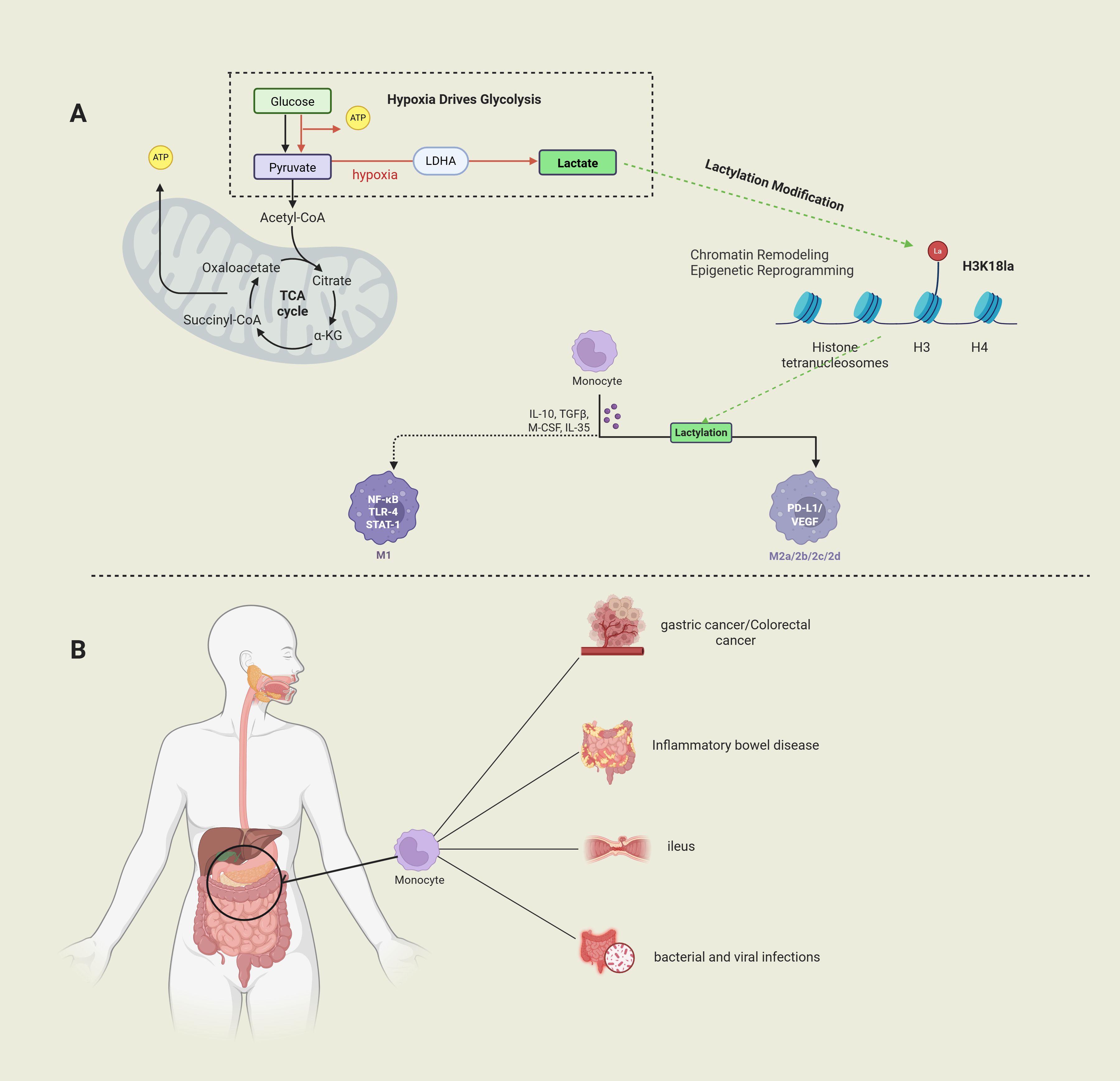 Diagram illustrating the process of hypoxia-driven glycolysis and lactylation modification. Panel A shows metabolic pathways involving glucose to lactate conversion, impacting chromatin remodeling via H3K18la. It details immune responses with monocyte differentiation to M1 and M2 phenotypes. Panel B depicts a human silhouette with monocyte connections to health conditions: gastric/colorectal cancer, inflammatory bowel disease, ileus, and infections. The interactions represent pathological outcomes linked to metabolic changes.