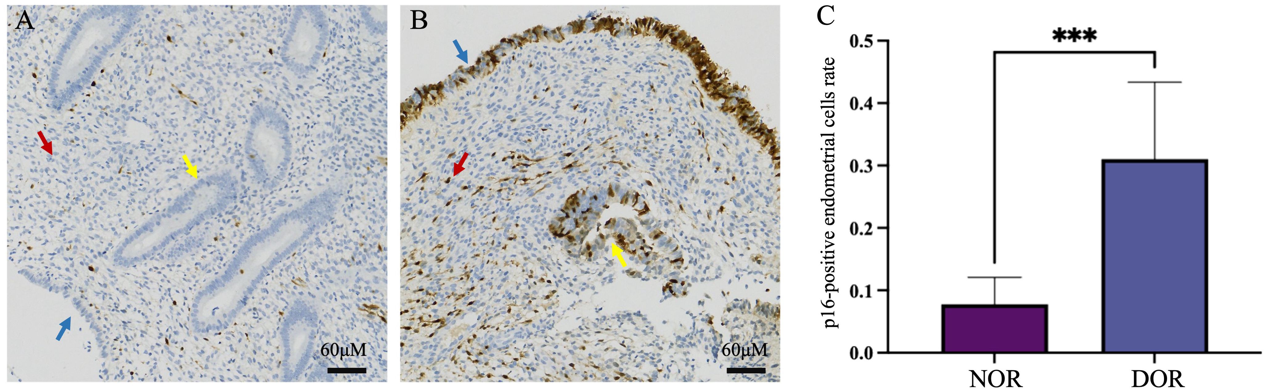Histological images and a bar graph. Panel A shows a tissue sample with sparse staining marked by red, blue, and yellow arrows. Panel B displays a denser staining in a different tissue sample, also marked by arrows. Both images have a scale bar of sixty micrometers. The bar graph compares the p16-positive endometrial cell rate between NOR and DOR groups, with significantly higher rates in the DOR group, indicated by triple asterisks.