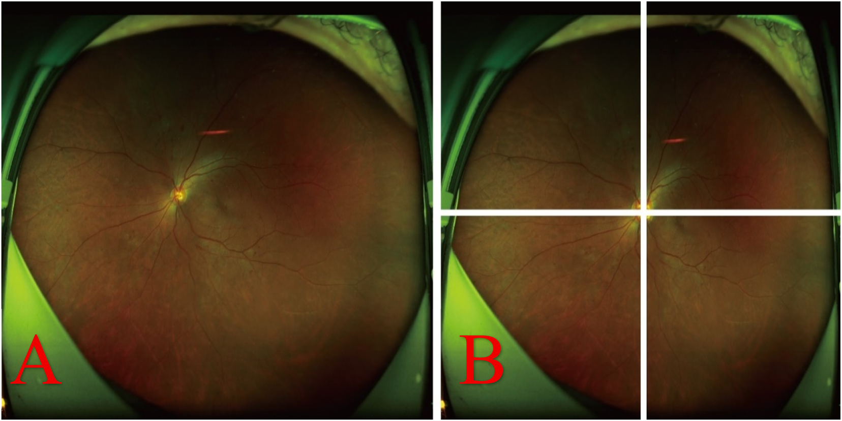Two retinal images labeled "A" and "B". Image A shows a clear view of the retina with visible blood vessels and the optic disc. Image B presents the same retinal view but is divided into quadrants with white lines. Both images have a greenish peripheral tint.