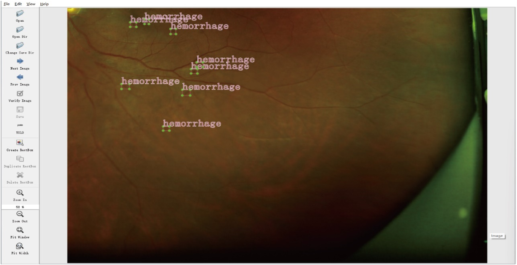 Retinal image showing multiple areas labeled "hemorrhage" with green markers indicating specific spots of interest. The interface includes options for viewing and editing images on the left.
