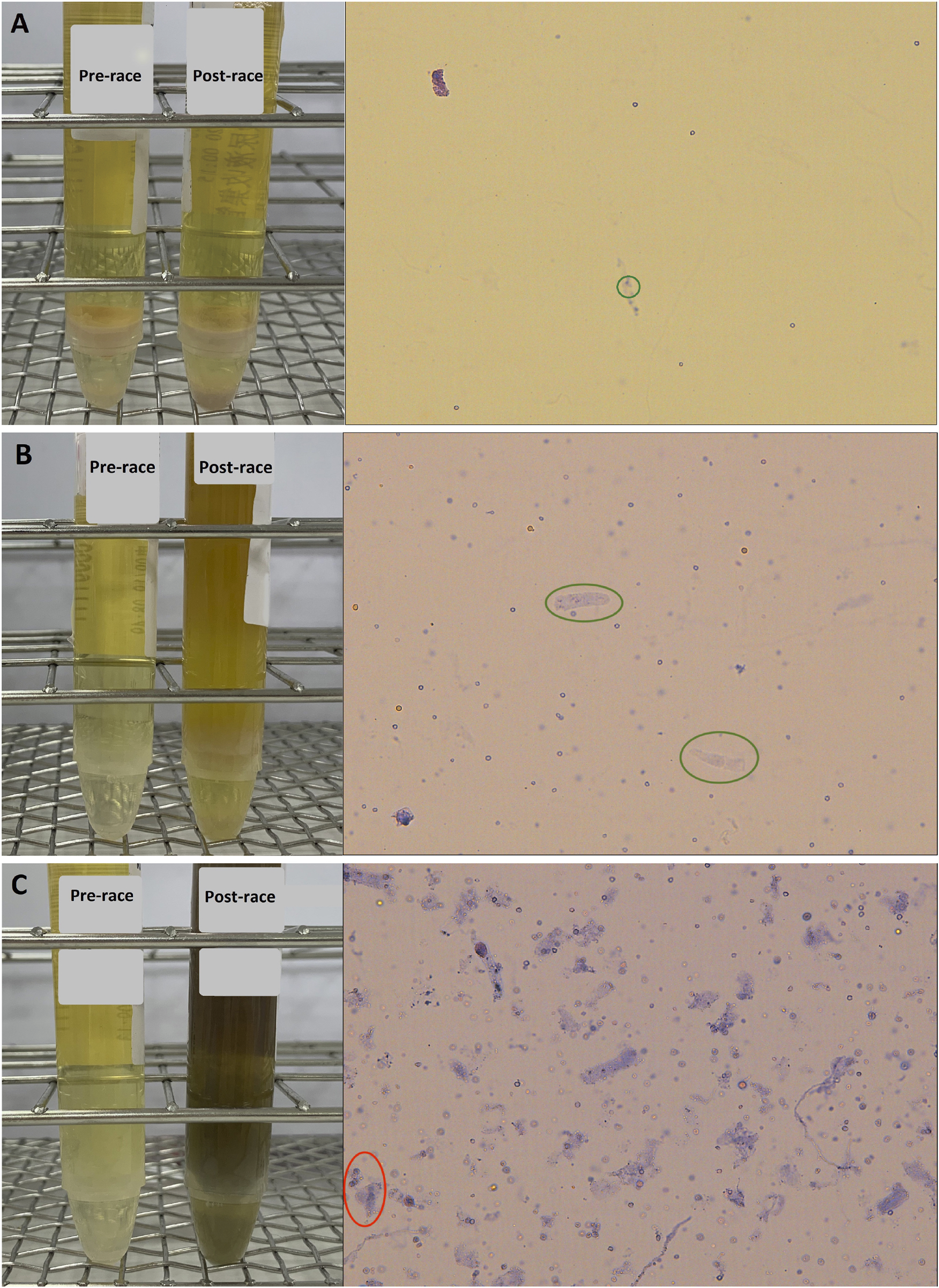 Three panels labeled A, B, and C show urine samples and microscopic images. Each panel has pre-race and post-race urine samples in test tubes. Microscopic views reveal variations in sediment or particles pre- and post-race. Panel A shows minimal particles, B shows moderate particles, and C shows a significant increase in particles, especially post-race.