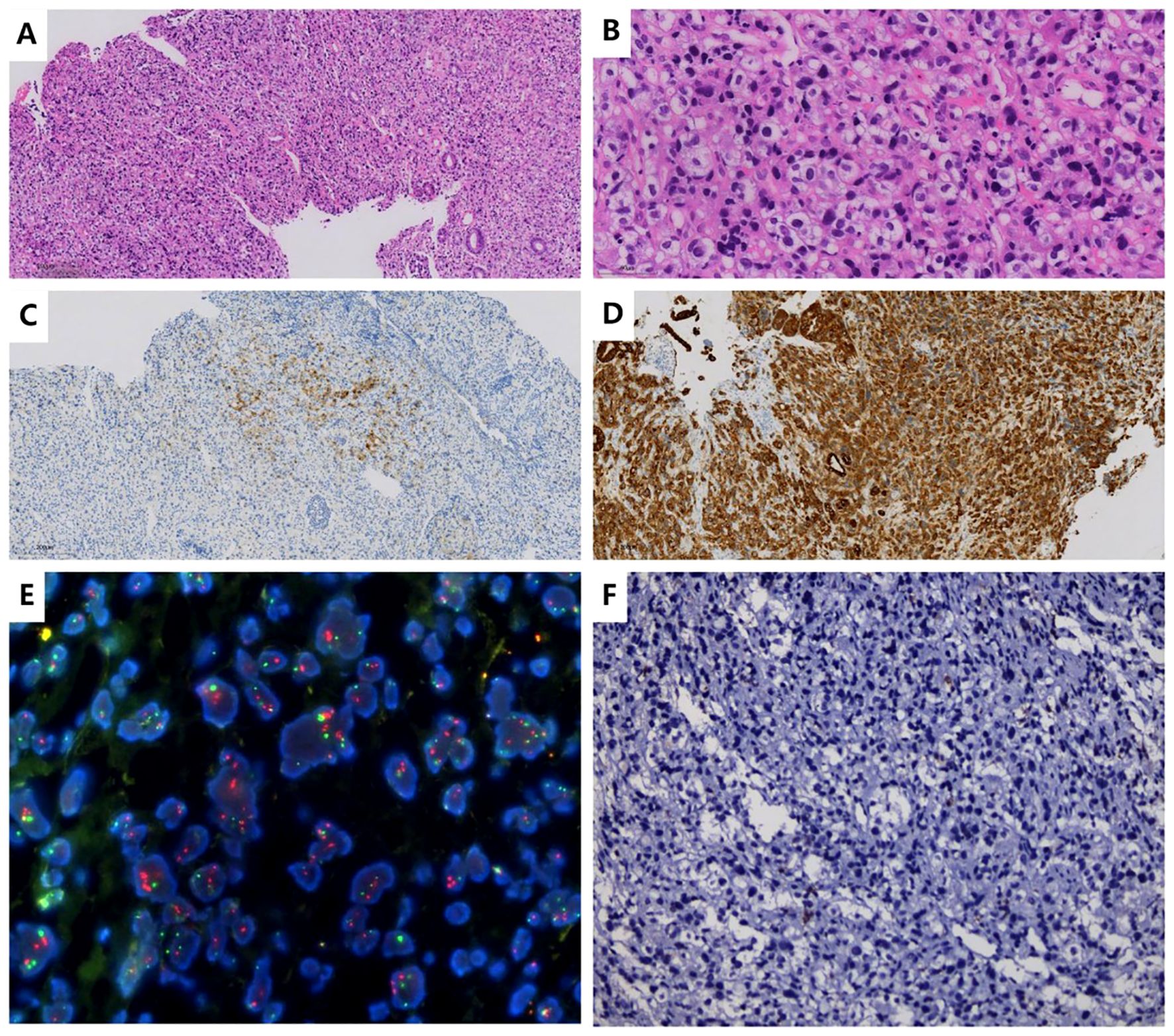 Panel A shows a histological section with numerous small, closely packed cells. Panel B presents a closer view of these cells, highlighting their varied shapes and sizes. Panel C depicts cells with a few brown-stained areas, which are highlighted in Panel D, where a dense brown stain covers many cells. Panel E shows brightly colored spots, indicating fluorescence against a dark background. Panel F displays a tissue section with many small, densely packed nuclei against a blue background.