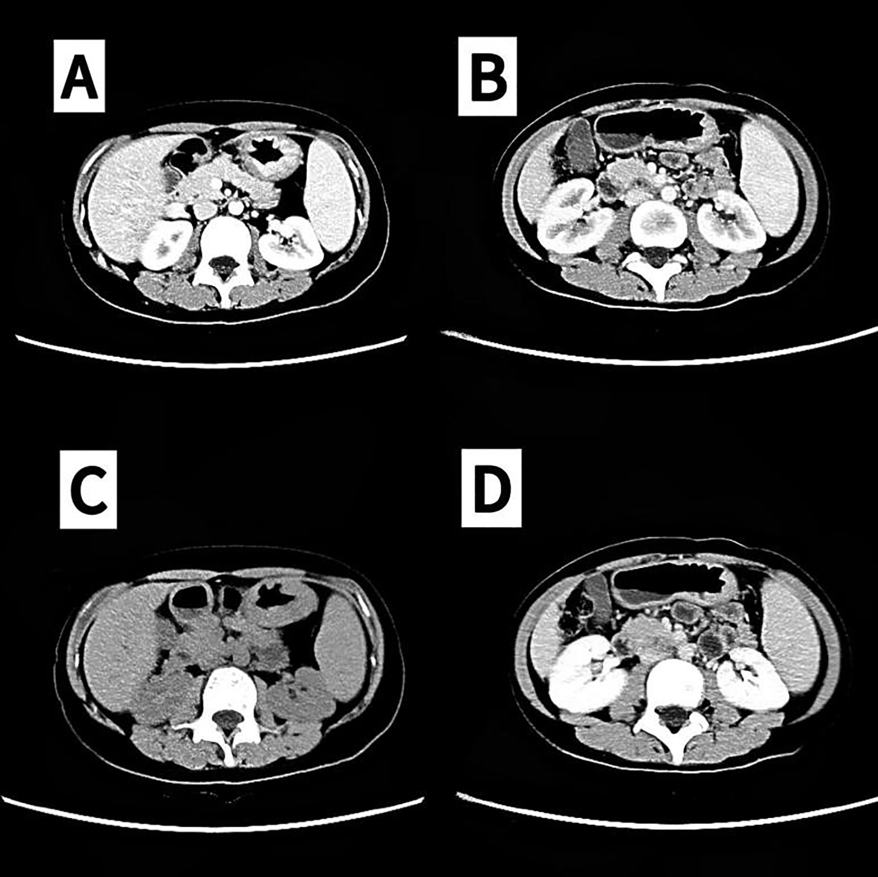 Panel A shows PET-CT scans indicating metabolic activity in the body. Panel B displays multiple PET-CT images showing cross-sectional views from different angles. Panels C and D are endoscopic images illustrating the interior of the colon, showing inflamed and reddened mucosa.