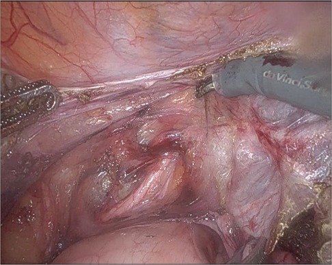 Surgical view inside a body cavity during a procedure with visible instruments, including one marked \