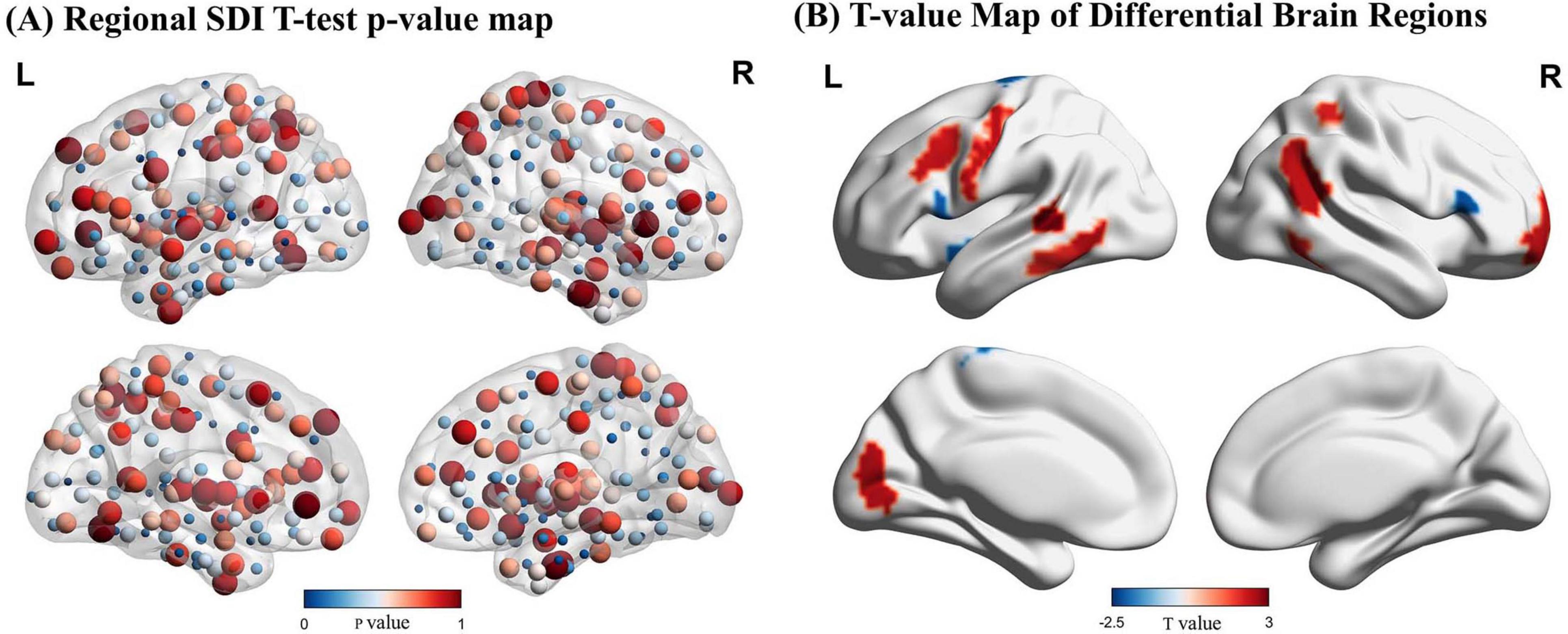 Regional SDI T-test p-value and T-value maps of differential brain regions are shown. Panel A illustrates p-value distributions with red and blue circles on brain models, indicating statistical significance. Panel B presents T-value maps with red and blue shaded areas on brain models, highlighting differential regions. Both panels include left and right hemisphere views with corresponding color scales for p-values and T-values.
