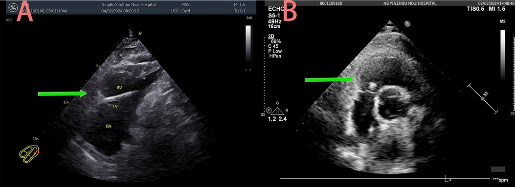 Ultrasound images labeled A and B displaying cardiac structures. Image A shows the right ventricle, tricuspid valve, and right atrium with a green arrow pointing to the hyperechoic foreign body. Image B focuses on the right ventricular, with a green arrow indicating hyperechoic foreign body. Both images include measurement scales and technical details.