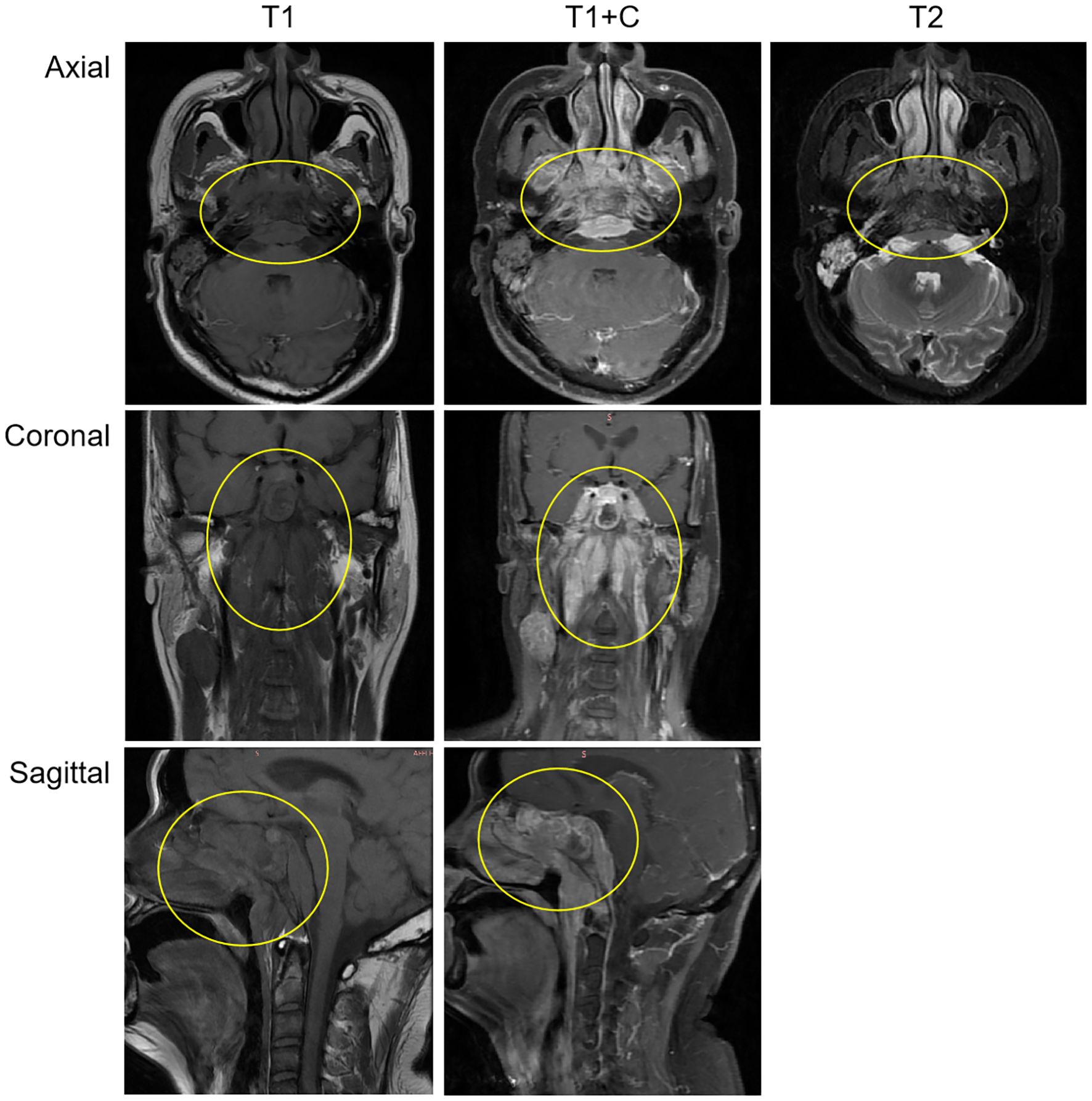 MRI scans of the head showing axial, coronal, and sagittal views across three different sequences: T1, T1+C, and T2. Each view highlights specific areas within yellow circles, indicating regions of interest for analysis.