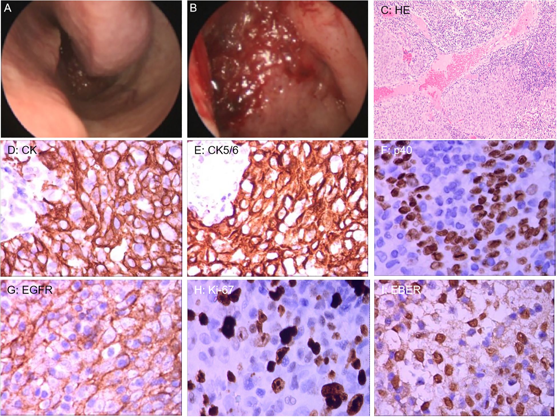 A composite of nine medical images includes endoscopic views, histological samples, and immunohistochemical stains. Top row: Endoscopic images A and B show tissue with varying appearances, and image C is an H&E stain displaying tissue structure. Middle row: Images D and E show CK and CK5/6 staining, highlighting cellular structures. Image F features p40 staining with dark brown nuclei against a lighter background. Bottom row: Image G shows EGFR staining, H shows Ki-67 with proliferating cells, and I depicts EBER staining indicating the presence of Epstein-Barr virus. Each panel illustrates different aspects of tissue analysis.