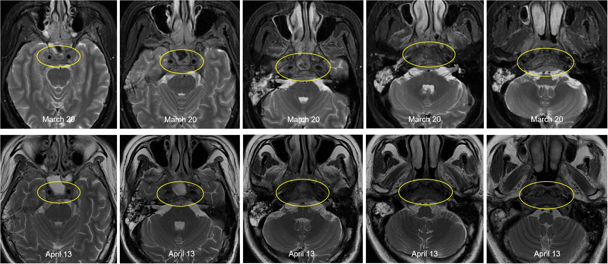 MRI scans in two rows show brain images with highlighted areas in yellow circles. The top row is dated March 20 and the bottom row April 13. Each set displays changes within the circled regions over time.