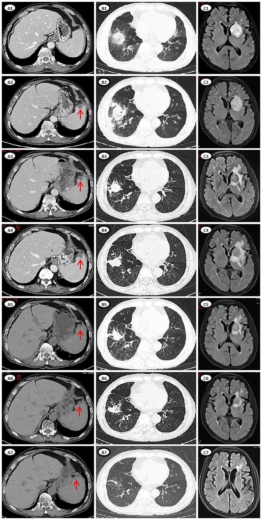 Multiple panels showing CT scans. The left column (A1-A7) displays abdominal scans with red arrows indicating specific areas. The middle column (B1-B7) presents pulmonary scans showing lung conditions. The right column (C1-C7) features brain scans with visible lesions. Each row corresponds to a set of scans from the same case.